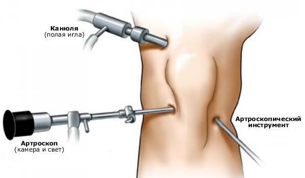 膝関節の関節鏡検査
