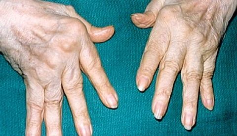指の関節の痛み