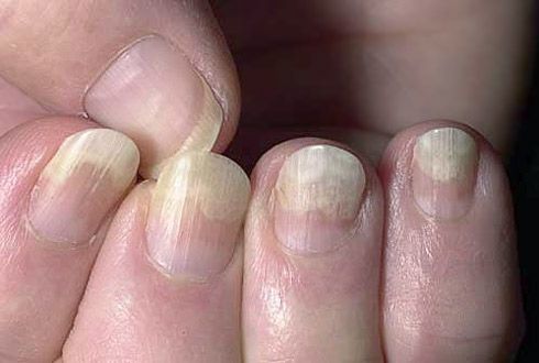 軟組織からの爪甲の剥離