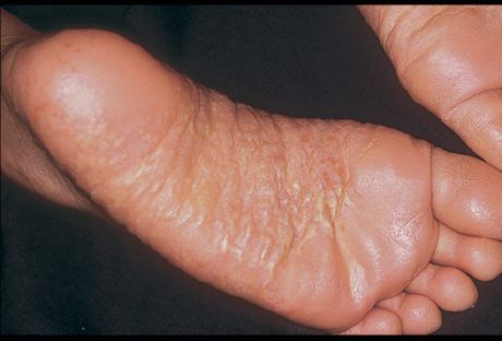 足の皮膚炎とその原因