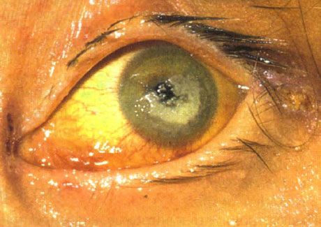 重篤な免疫不全の子供のカンジダによる両側性角膜炎