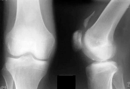 膝関節のレントゲン