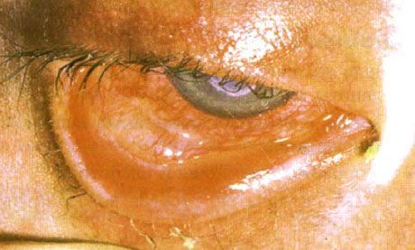 症候群スティーブンス・ジョンソン。 壊死の領域を伴う両側剥離性結膜炎。 重い角膜炎。角膜に傷跡が現れました。 状況は「乾いた」目の症候群の追加によって複雑になった