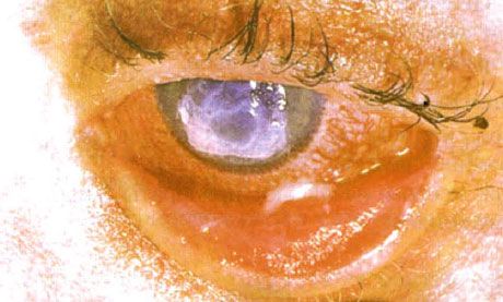 症候群スティーブンス・ジョンソン。 壊死の領域を伴う両側剥離性結膜炎。 重い角膜炎。角膜に傷跡が現れました。 状況は「乾いた」目の症候群の追加によって複雑になった