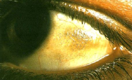 Xerophthalmus。 Bitoのプラークは、眼瞼で覆われていないゾーンに位置する複数の鱗屑、結膜炎部位の沈着とともに上昇しているように見える。 この場合、病理学的領域はしばしば色素沈着する。