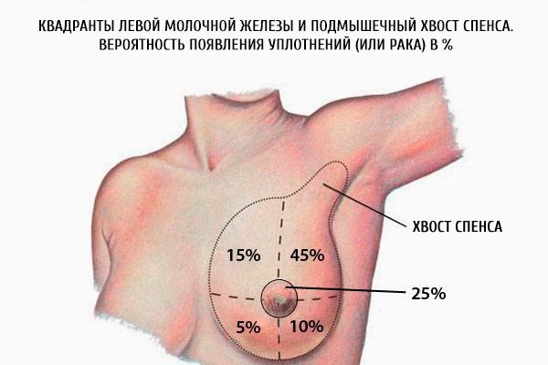 左胸部の四分円と紡錘形の腋窩の紡錘形。 シール（または癌）の可能性は％