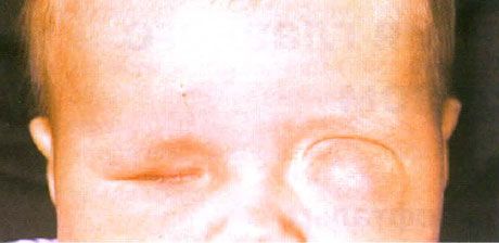 付随する嚢胞形成を伴う微小眼（左眼）。 Anophthalmus（右目）。