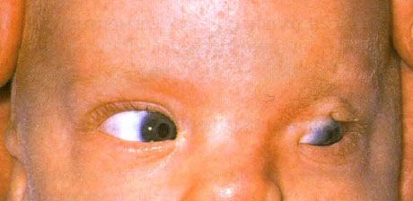 フレーザー症候群。 左眼の不完全なクリプトフタルモス。