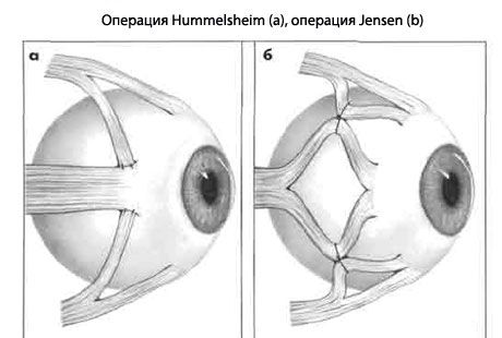 視神経 - 手術