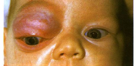 眼窩前窩と上瞼の毛細血管腫。 新生物は進行する傾向がある