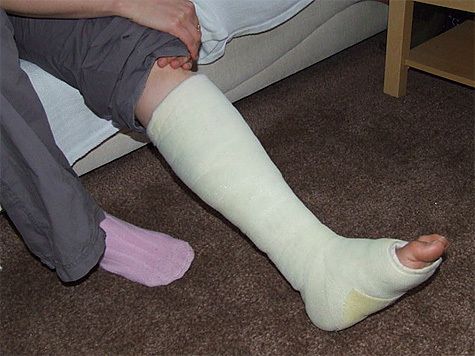 自宅での脚の骨折の対策