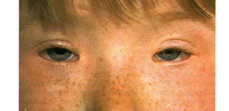 視力低下症の症候群。 両側性眼瞼下垂症、テレカンサスおよび眼瞼炎