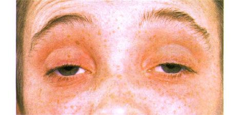 外部眼麻痺  両面眼瞼下垂。 患者は眉を上げて目を開きます