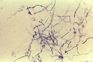 トリコフィトーシス Trichophytosis トリコフィトン Trichophyton の原因物質は