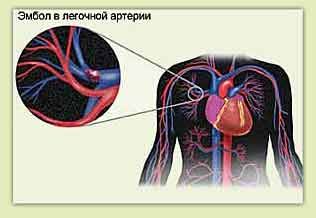 左肺塞栓症と胸痛