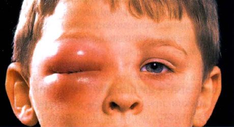 小児の体外膿瘍